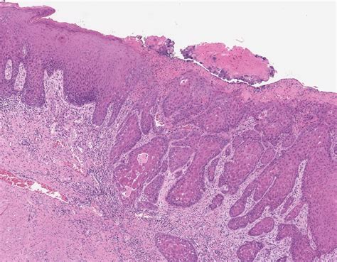 Squamous cell carcinoma - Lips, mouth, and tongue - MyPathologyReport