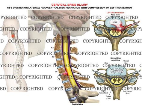 C5-6 left posterolateral, paracentral disc protrusion- male — Medical Art Works