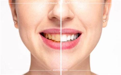 How teeth whitening trays work? | ilajak