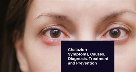 Chalazion - Symptoms, Causes, Diagnosis, Treatment and Prevention - Americanpainsociety.Org