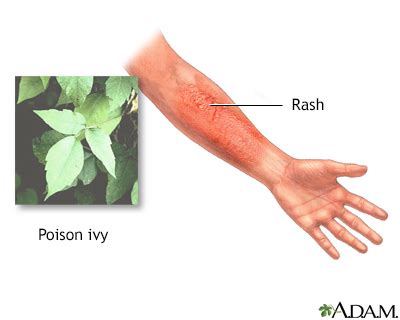 Poison Sumac Rash