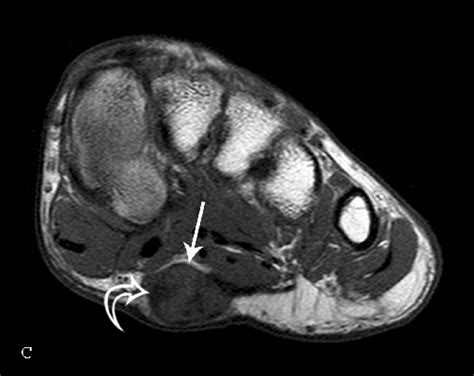 Ledderhose disease - Physiopedia