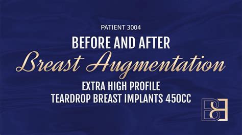 450cc Breast Implants {Patient 3004} (Augmentation Mammaplasty) Before ...