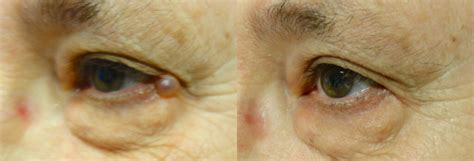 Eyelid Growth Removal Archives - In Focus Ophthalmic Plastic Surgery