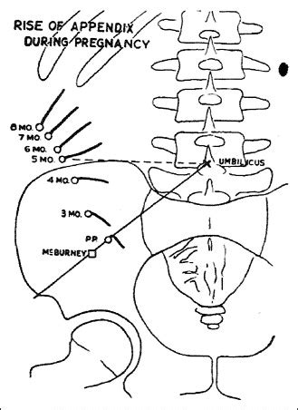 The incision of choice for pregnant women with appendicitis is through ...