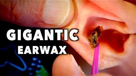 GIGANTIC EARWAX REMOVAL! | Dr. Paul - YouTube