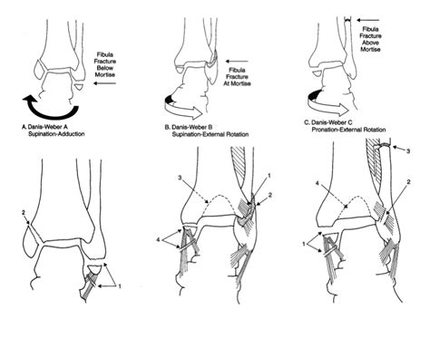 emDOCs.net – Emergency Medicine EducationCORE EM: Ankle Stress Views: Why, When + What - emDOCs ...