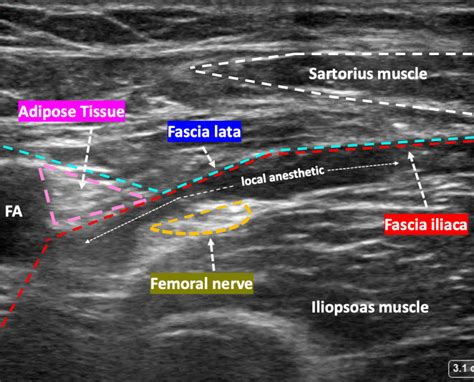 Fascia Iliaca Label ultrasound anatomy - ALiEM