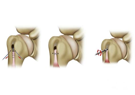 Tenodesis Shoulder Tendon Surgery Photograph by Maurizio De Angelis ...