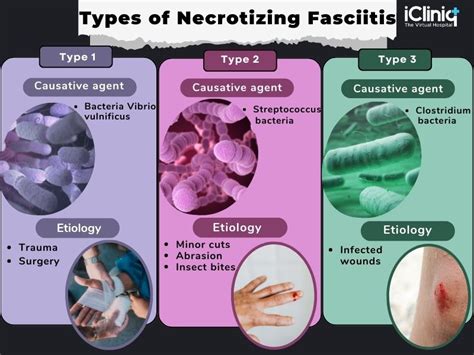 Necrotizing Fasciitis Types