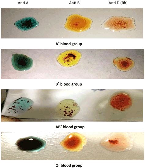 Frequency of expression and the distribution of ABO and Rh, Blood group antigens in the ...