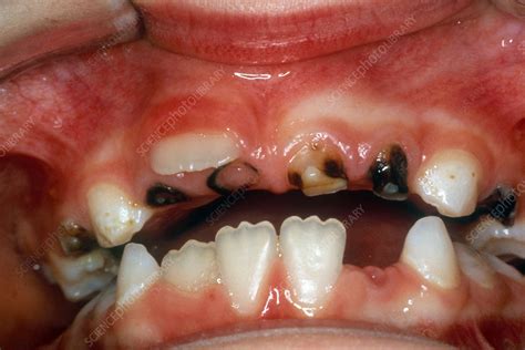Severe Tooth Decay in Child - Stock Image - C039/3018 - Science Photo Library