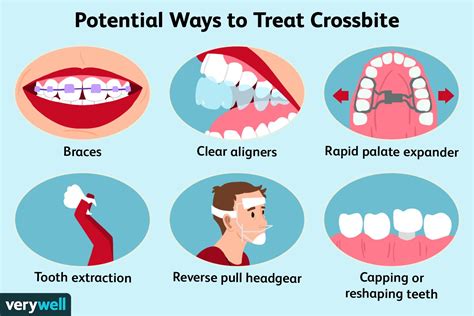 Crossbite: Definition, Causes, and Treatment