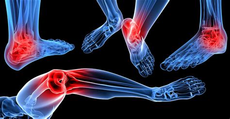 Foot Arthritis Treatment Alberta: The Foot Institute