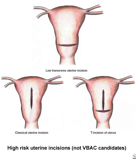 Cesarean Section (C-Section) Birth Procedure: Recovery & Scar Healing