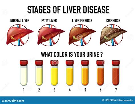 Stages Of Liver Damage. The First Symptoms Of Liver Problems Are Abdominal Pain, Swollen Belly ...