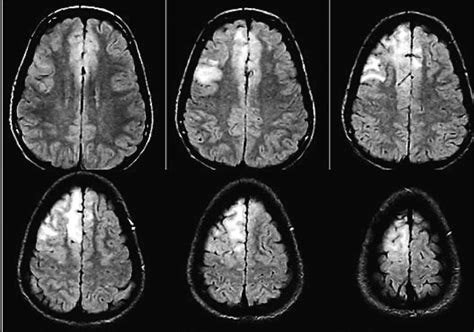 Bilateral Rasmussen syndrome: confluent and subcortical FLAIR/T2 ...