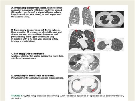 Cystic lung disease; Stepwise approach to diagnosis