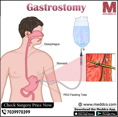 Your complete guidance towards Gastrostomy