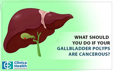Things you must do if you have cancerous gallbladder polyps.