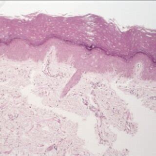 Palmar edema and erythema, with fine desquamation (palmar plantar... | Download Scientific Diagram