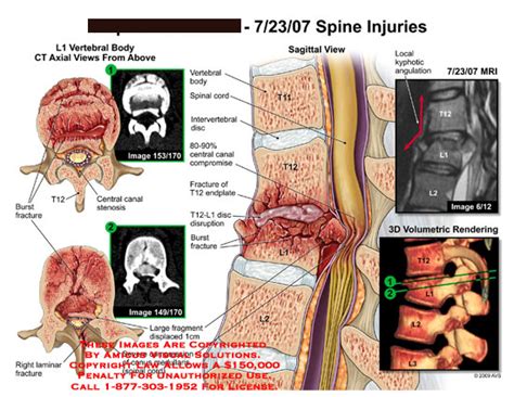 AMICUS Illustration of amicus,injury,spine,ct,L1,vertebrae,burst,fracture,T12,central,canal ...