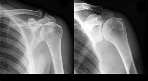 Shoulder Hemiarthroplasty - Shoulder & Elbow - Orthobullets