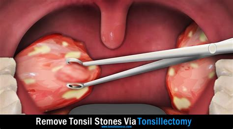 Tonsil Stones Removal Guide [2022]