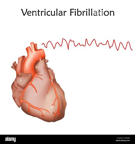 Atrial Fibrillation Animation Gif