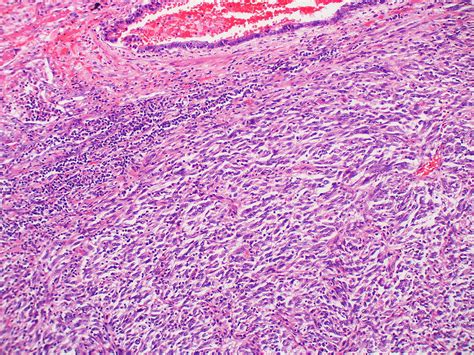 Metastatic melanoma Case 171 | Amelanotic melanoma with spin… | Flickr