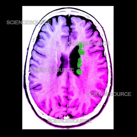 Photograph | Heterotopic Gray Matter, MRI | Science Source Images