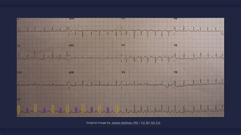 Electrical Alternans ECG - YouTube