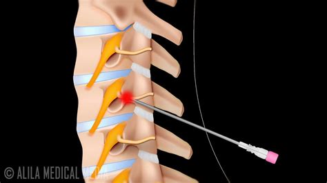 Cervical Radiofrequency Neurotomy Procedure - YouTube