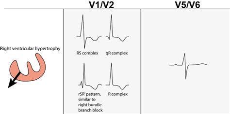 Right Ventricular Hypertrophy ECG Criteria