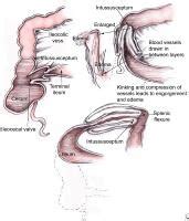 Pediatric Intussusception Surgery