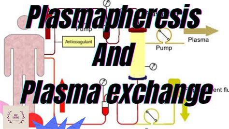 Plasmapheresis, Part-3/Plasmapheresis procedure/Methods of plasma ...