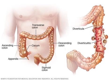 Diverticulitis: Sacs in Colon - Word-of-Health