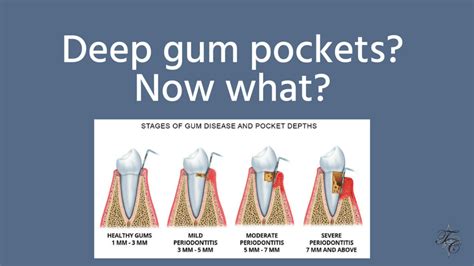 Deep gum pockets | Tim Chauvin Dental Lafayette La