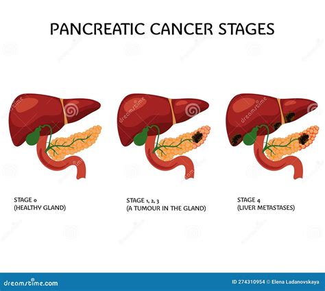 Pancreatic Cancer Stages Pancreas Medical Poster 向量例证 - 插画 包括有 症状, 医生: 274310954