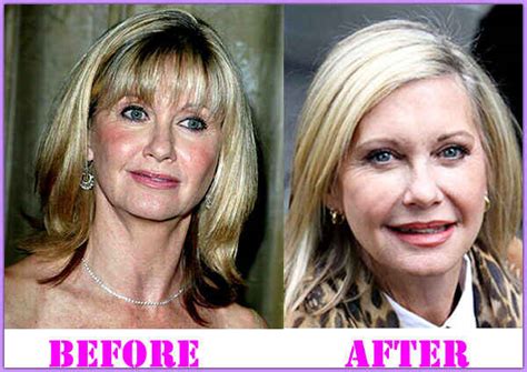 Olivia Newton John Facelift, Botox and Facial Fillers Plastic Surgery Before and After (Star ...