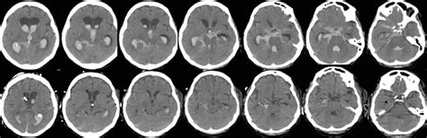 Intraventricular Hemorrhage - New Jersey Brain and Spine