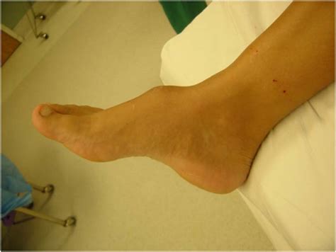 tumor of the foot | The Foot and Ankle Online Journal