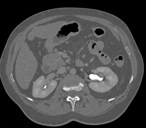 Clot in Lower Pole Calyx Left Kidney / CTisus.com in 2021 | Kidney, Case study, Medical imaging