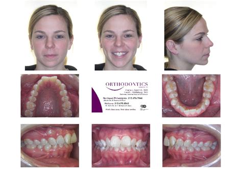 Invisalign Before and After Invisalign Reviews Philadelphia