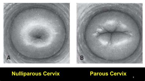 Puerperium and Postpartum Period | PPT