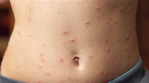 Itching: What’s Causing Your Itchy Skin? (with Pictures)