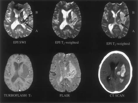 MRI Features of Intracerebral Hemorrhage Within 2 Hours From Symptom Onset | Stroke