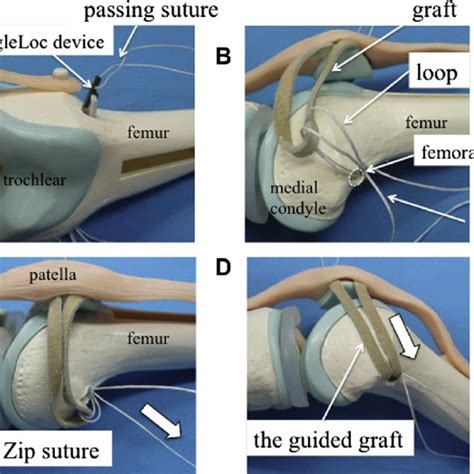 Guidance of tendon graft. First, the patellar side of the tendon graft... | Download Scientific ...