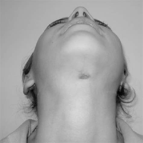 Cutaneous sinus tract on the midline of the cervical region over the ...