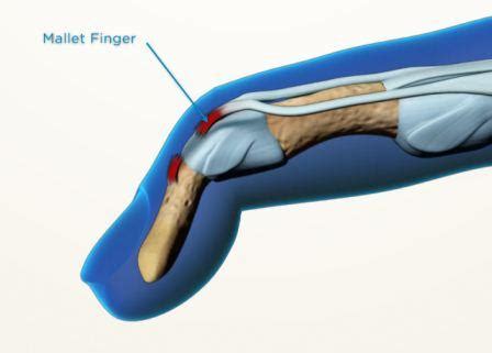 Mallet finger injury - Melbourne Hand Surgery